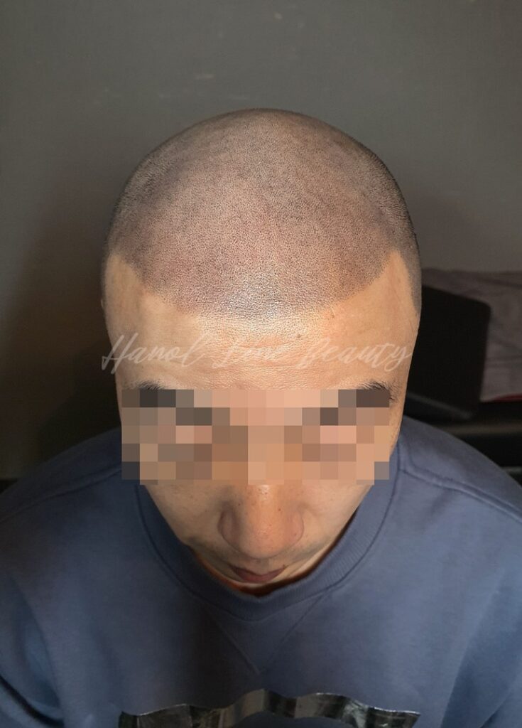 두피밀도보강