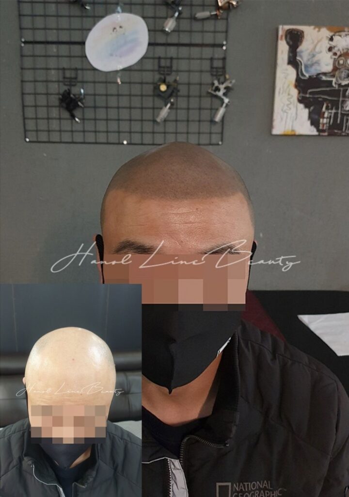 두피타투