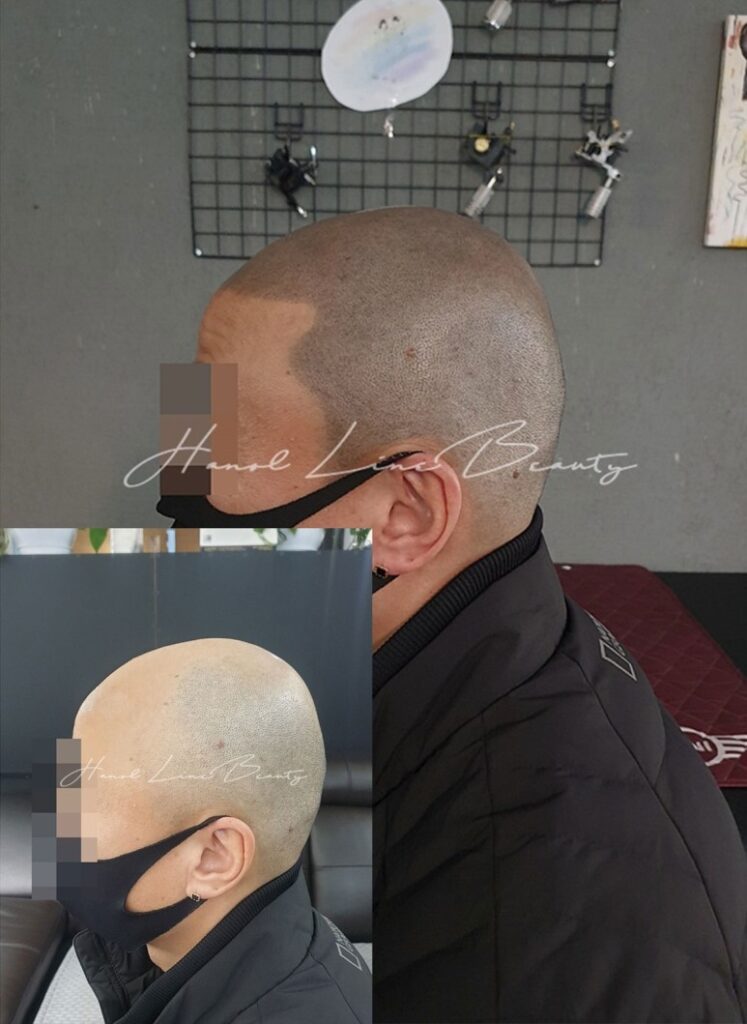머리흉터커버
