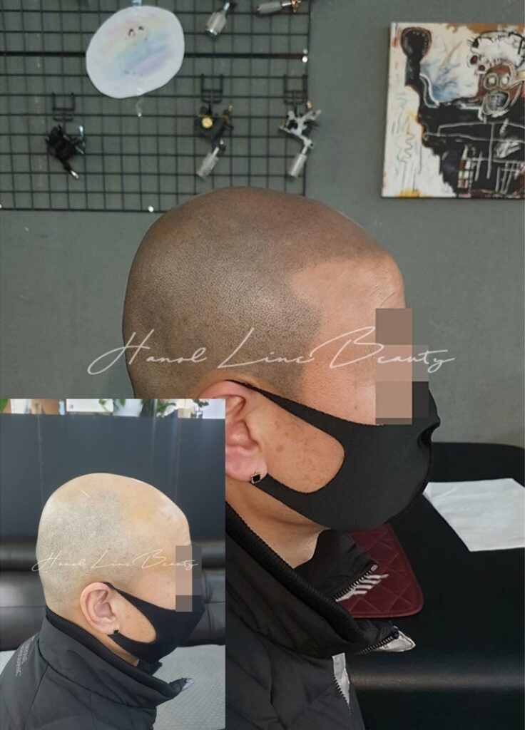 대머리문신