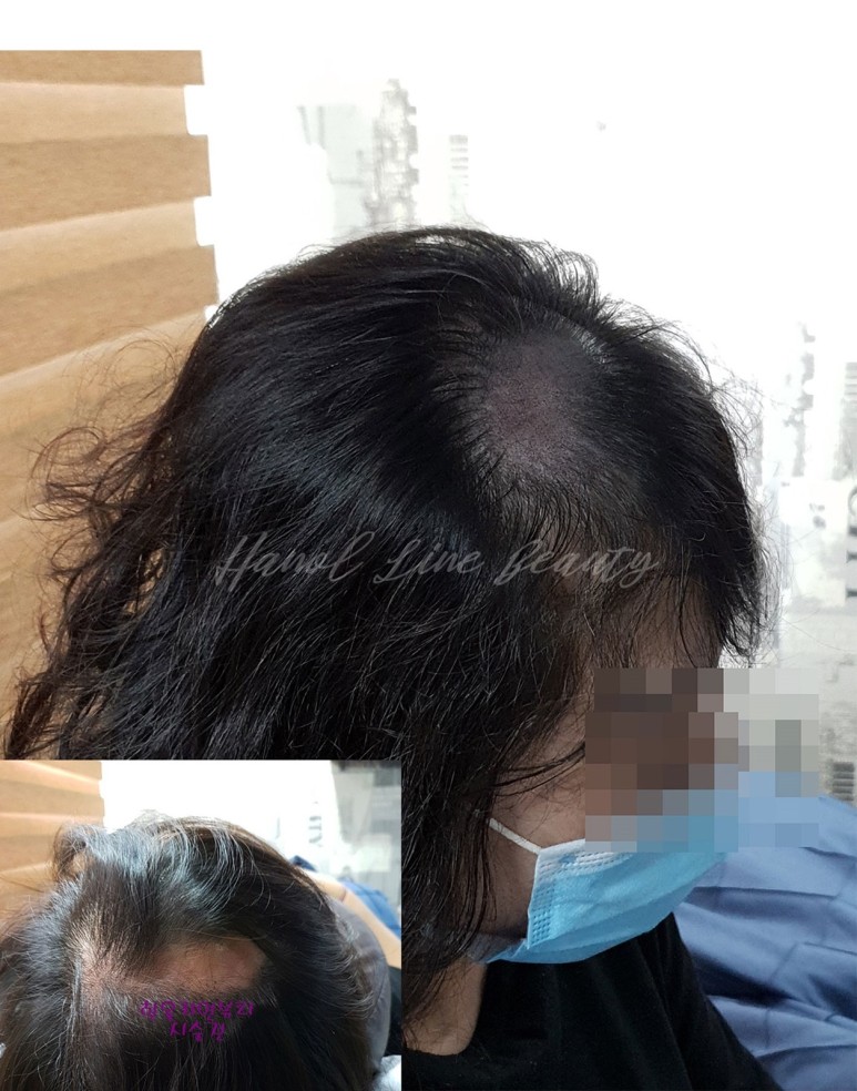 야당동두피문신