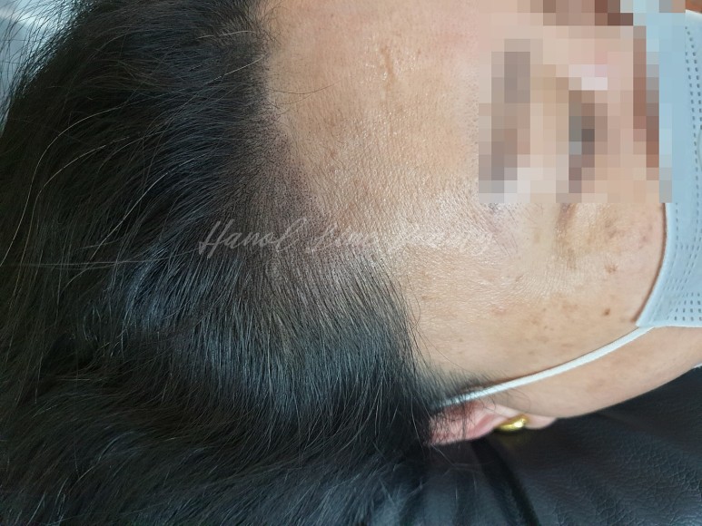 장항동두피문신