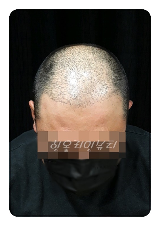강서두피문신