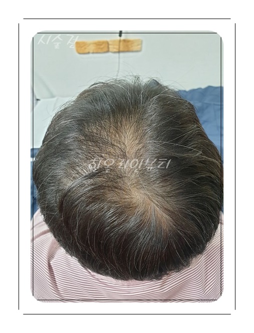 일산두피문신