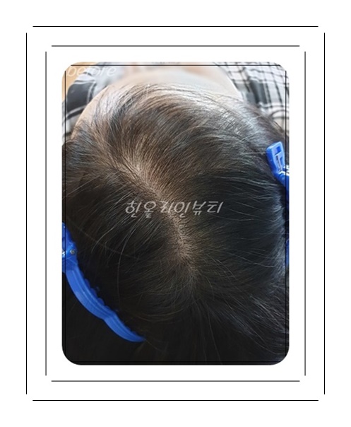 일산두피문신