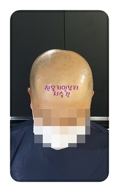 김포두피문신