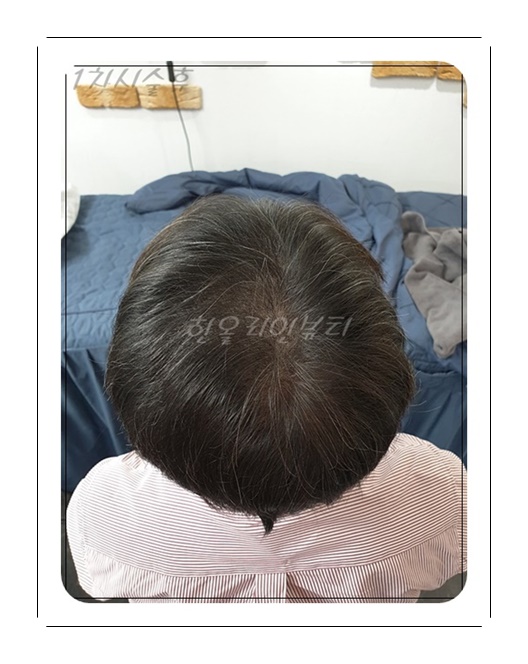 일산smp두피문신