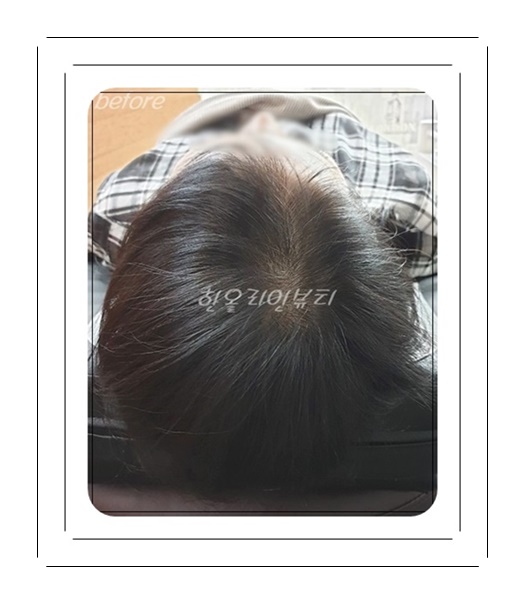 일산smp두피문신