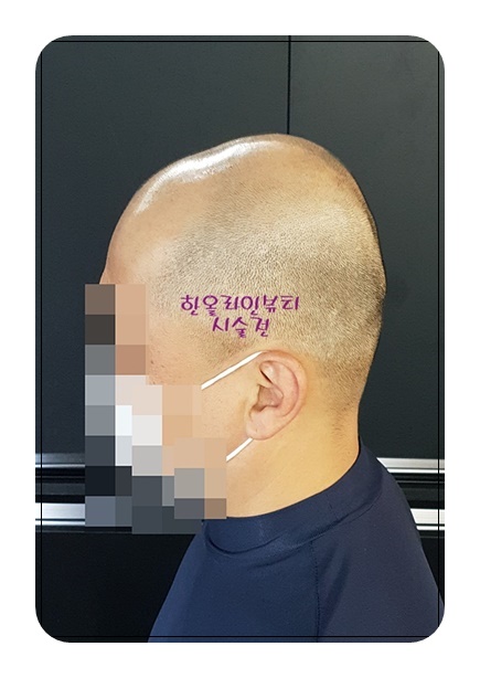 김포두피타투