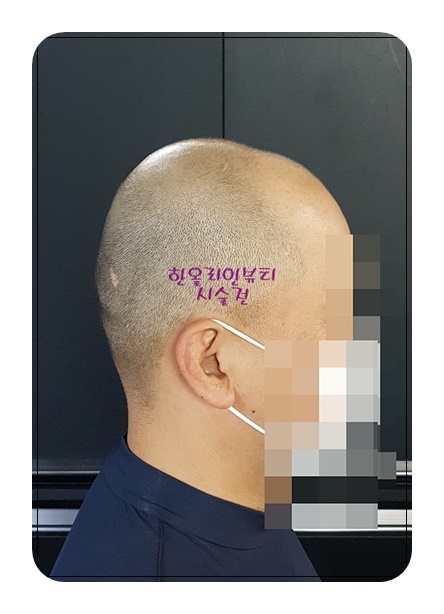 김포smp두피문신