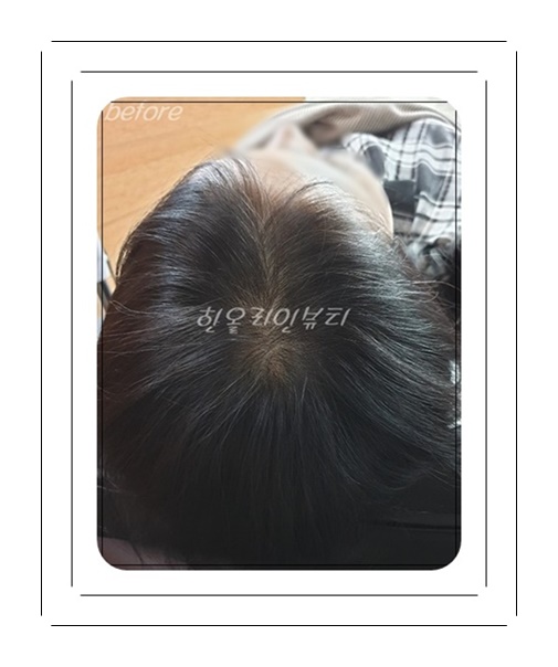 압구정두피문신