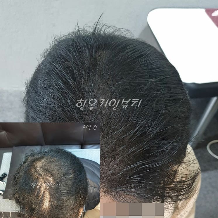 일산smp두피문신