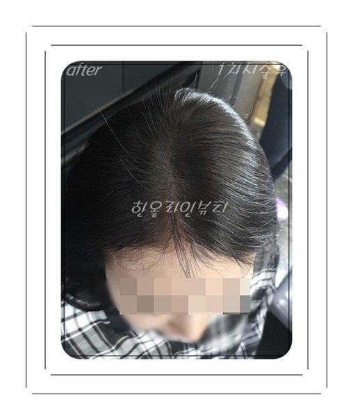 여성두피문신