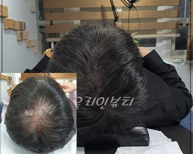 정수리두피문신