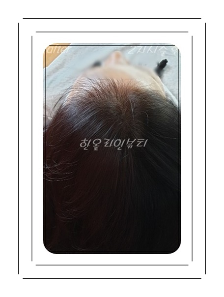 정수리두피문신