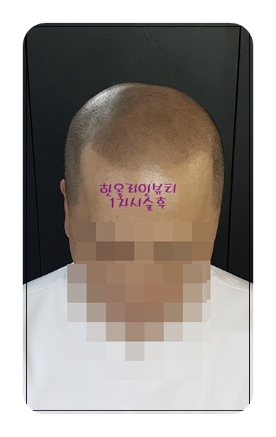 민머리탈모커버