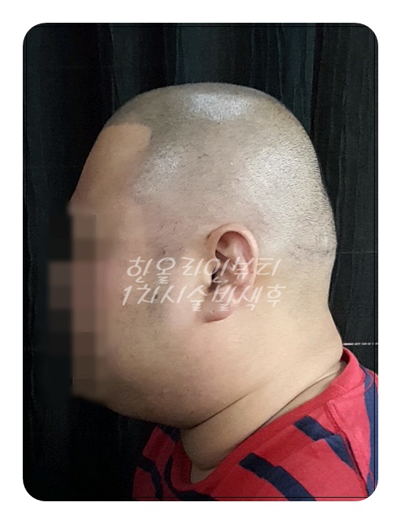 목동두피문신