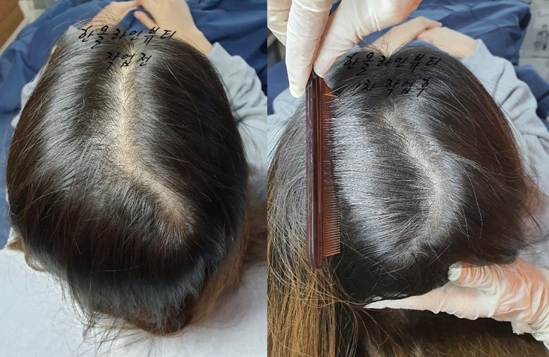 구래동두피문신