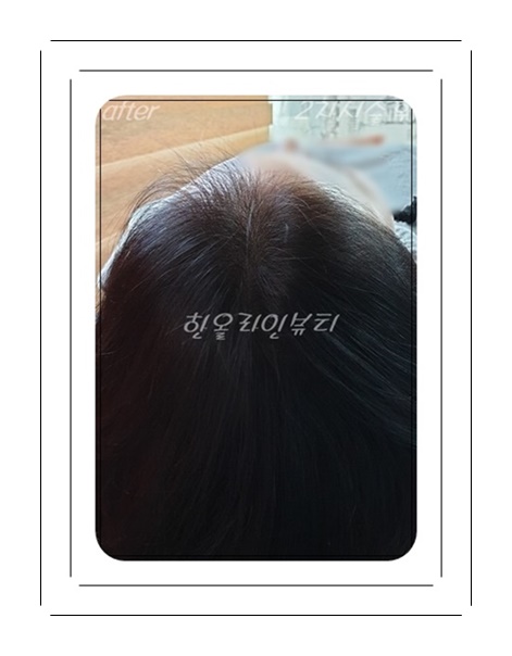 여성탈모커버