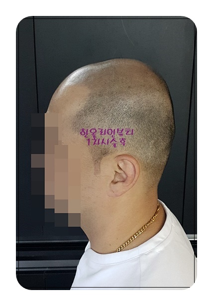 대머리탈모커버