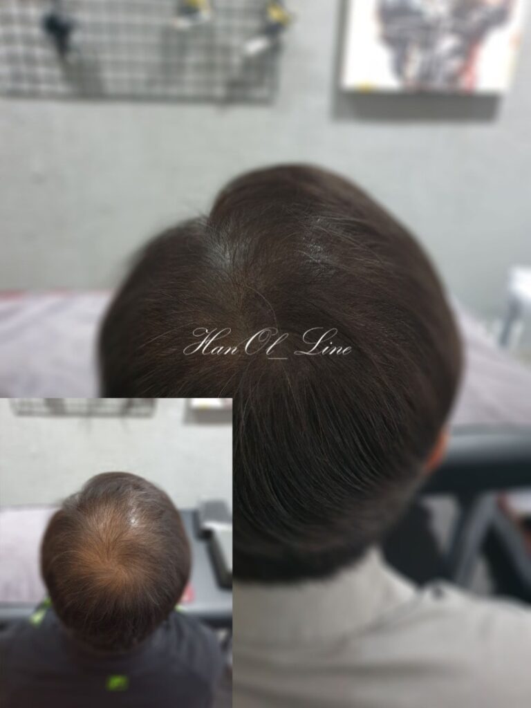 대머리문신