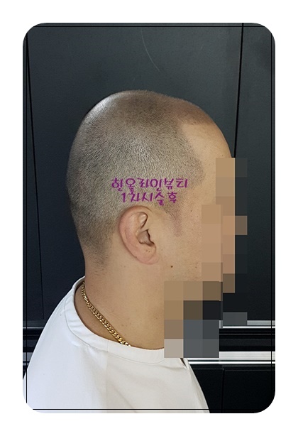 정수리두피문신