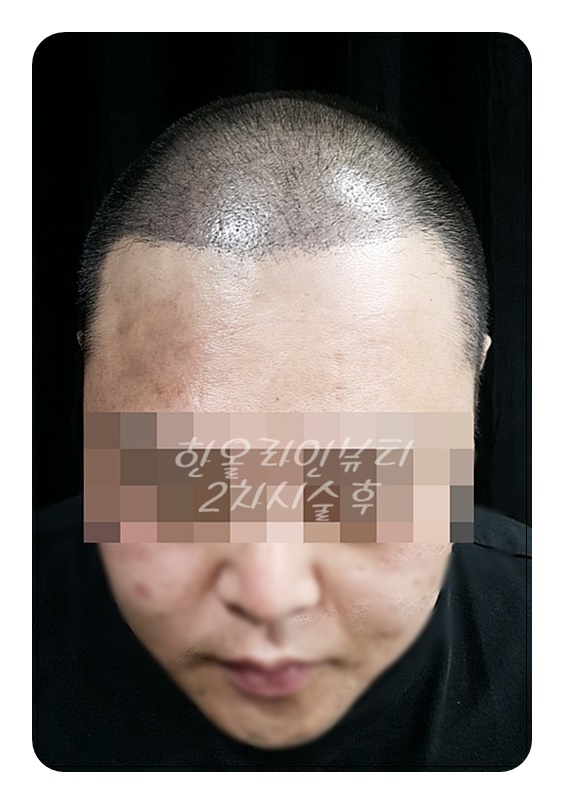 모발이식후밀도보강