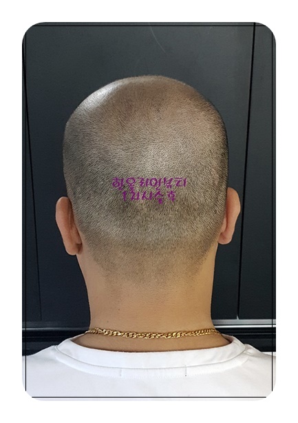 두피탈모커버