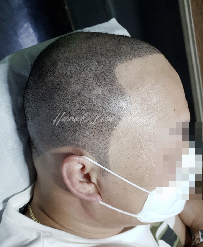 양촌두피문신