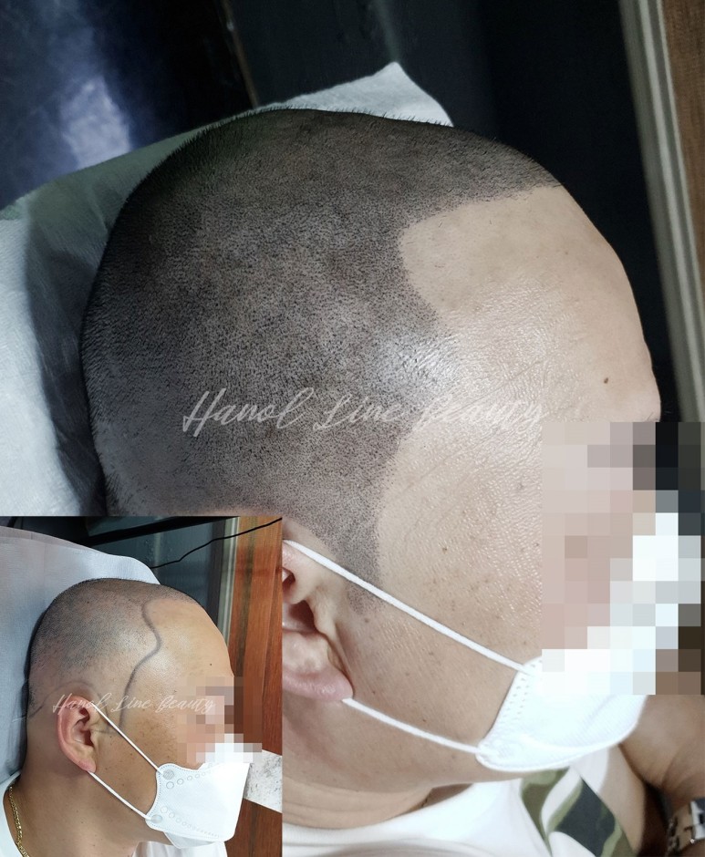 양곡두피문신