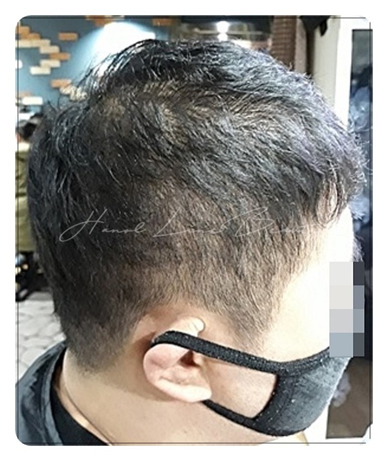두피문신
