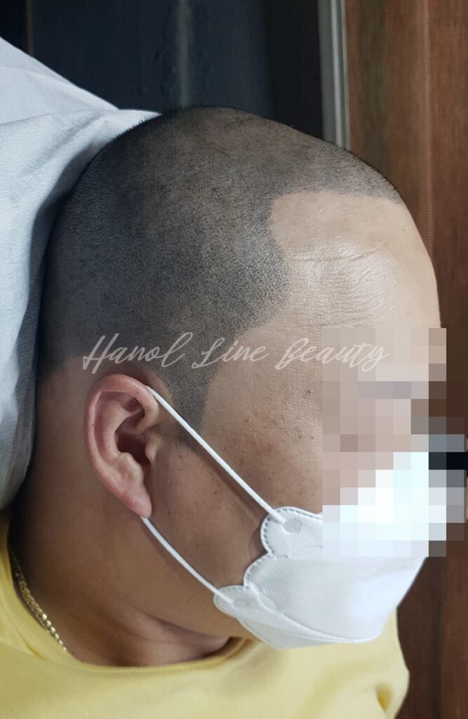 장기동두피문신