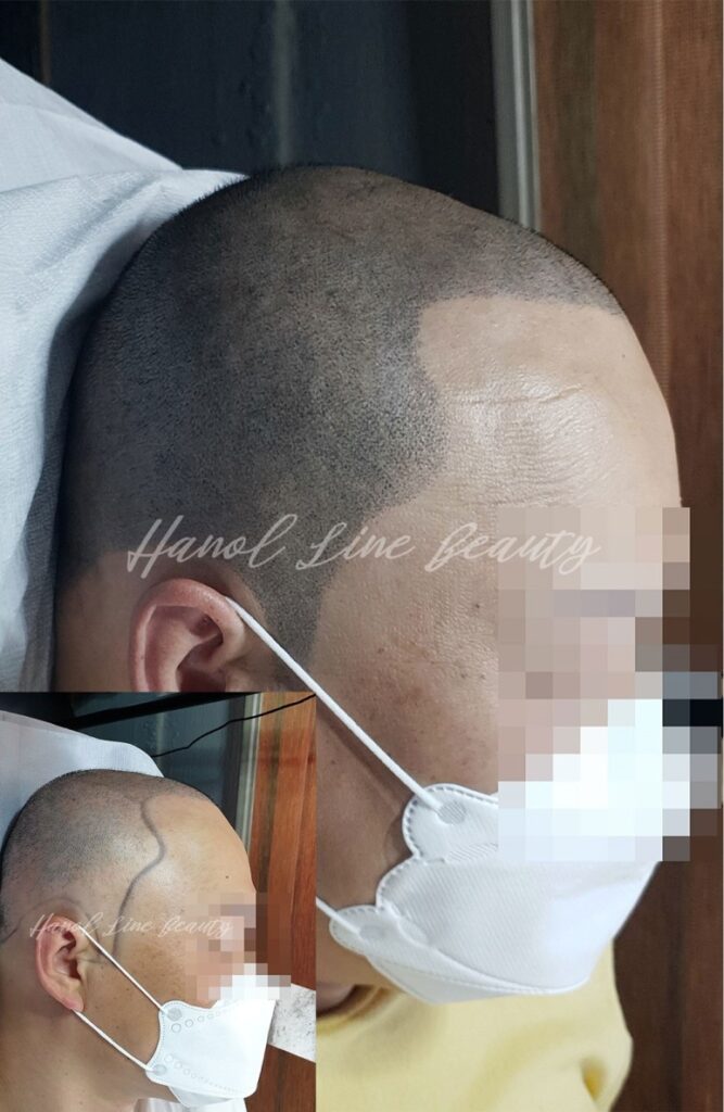 운양동두피문신