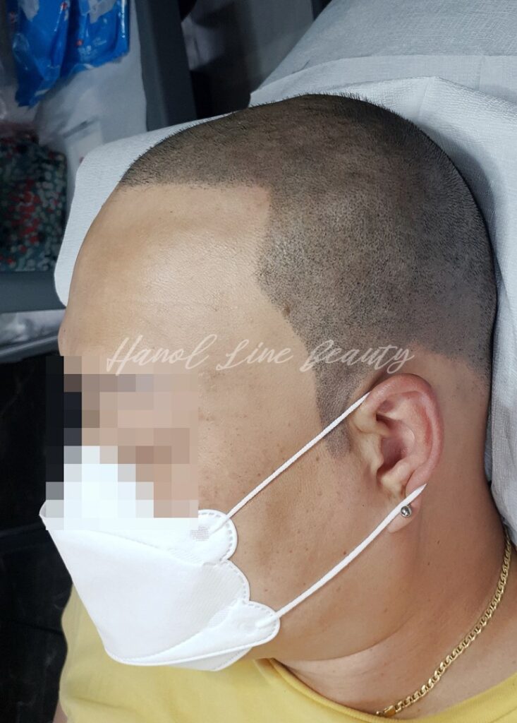 고촌두피문신