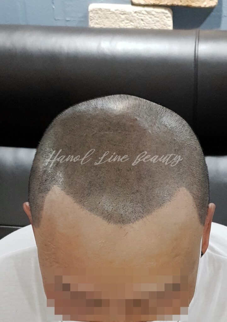 여성두피문신