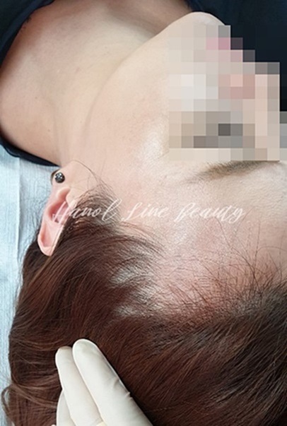 파주smp두피문신
