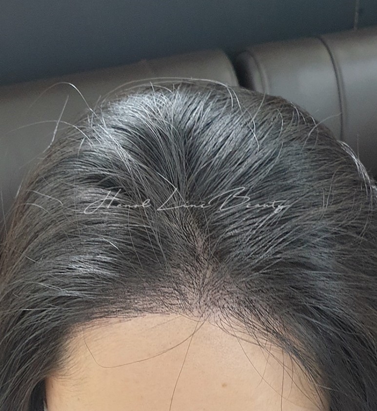 일산탈모커버