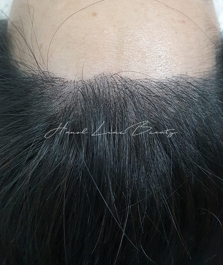 여성두피문신전문