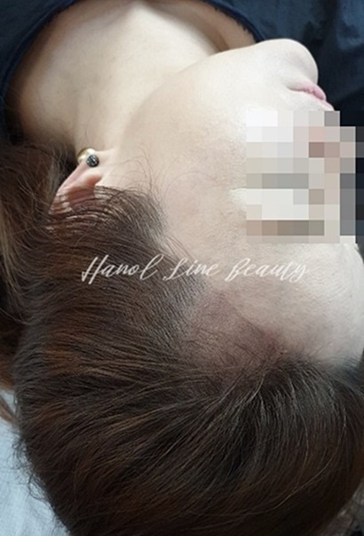 여성헤어라인