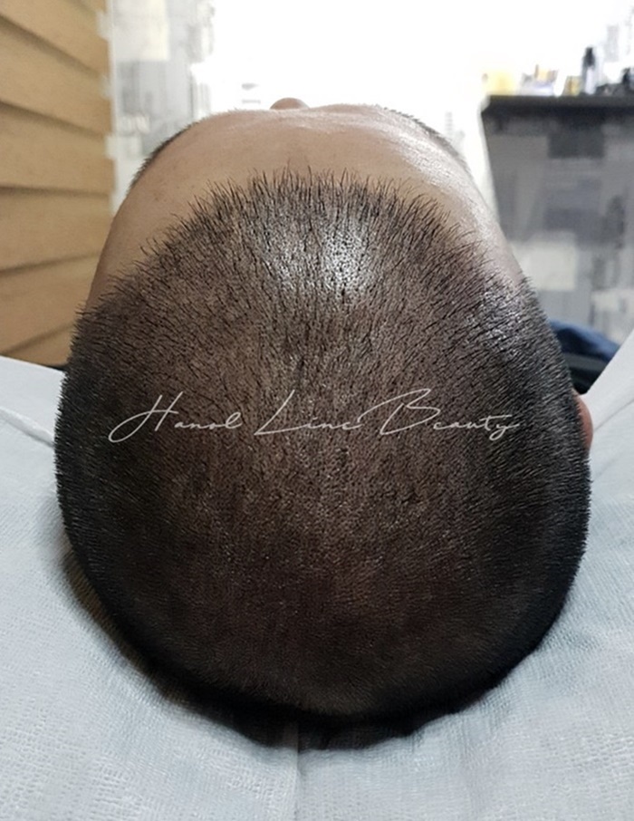 모발이식후