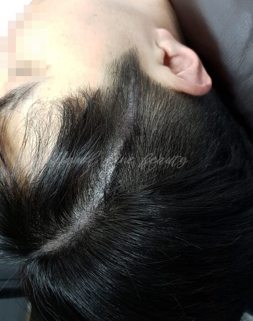 모발이식후