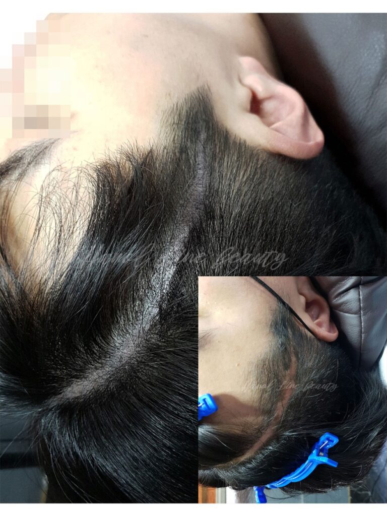 화정두피문신