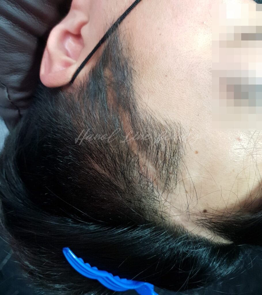 두피문신의 성지