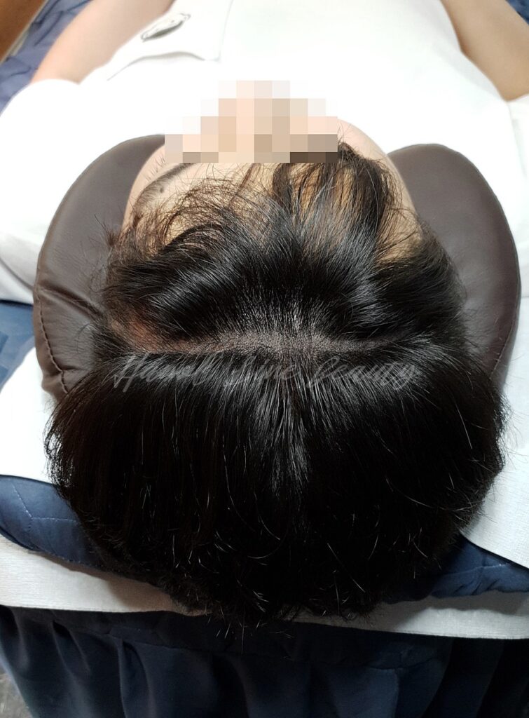 smp두피문신