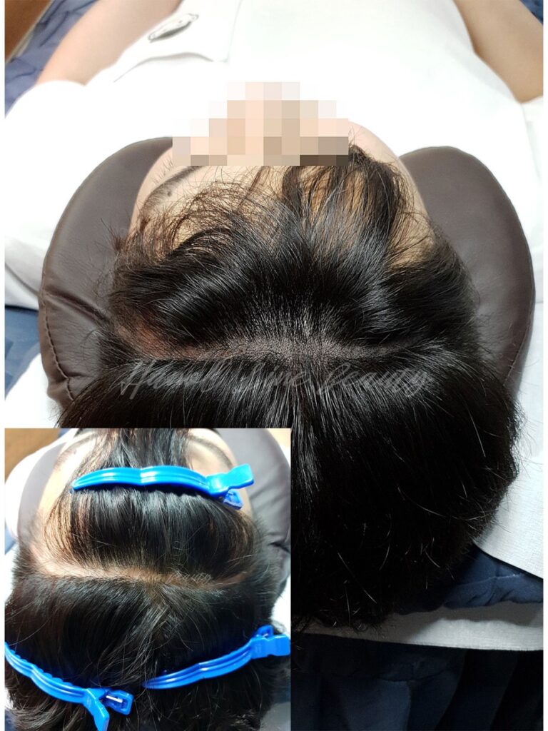일산smp두피문신
