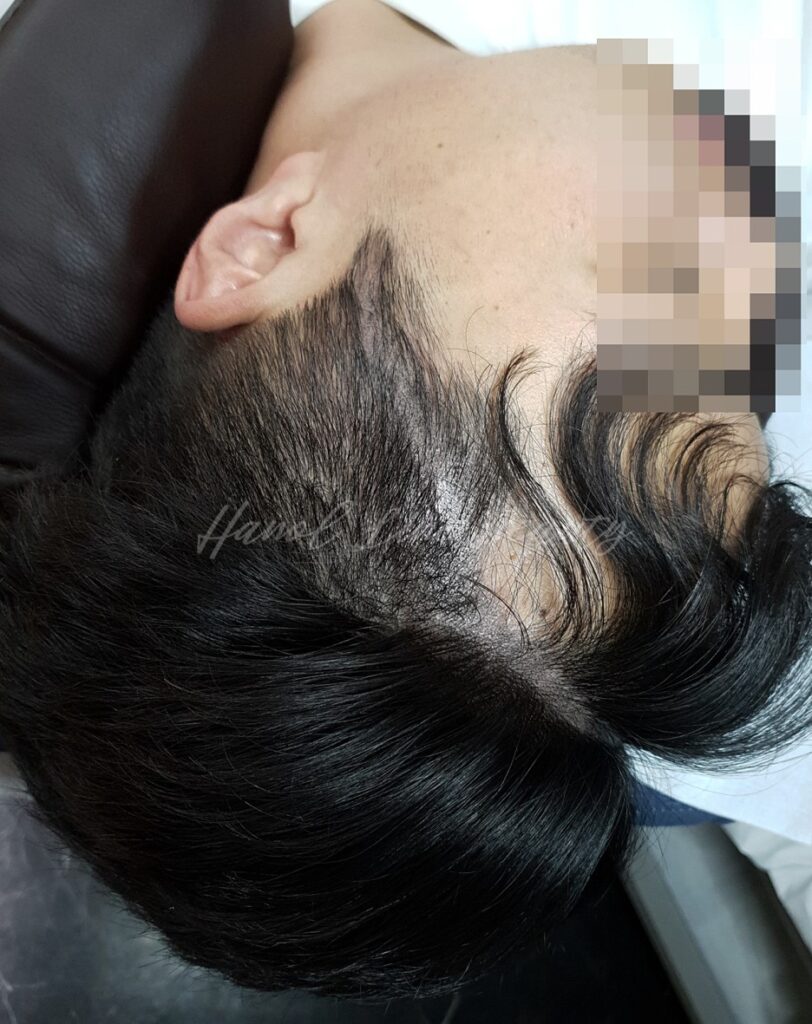 탈모커버