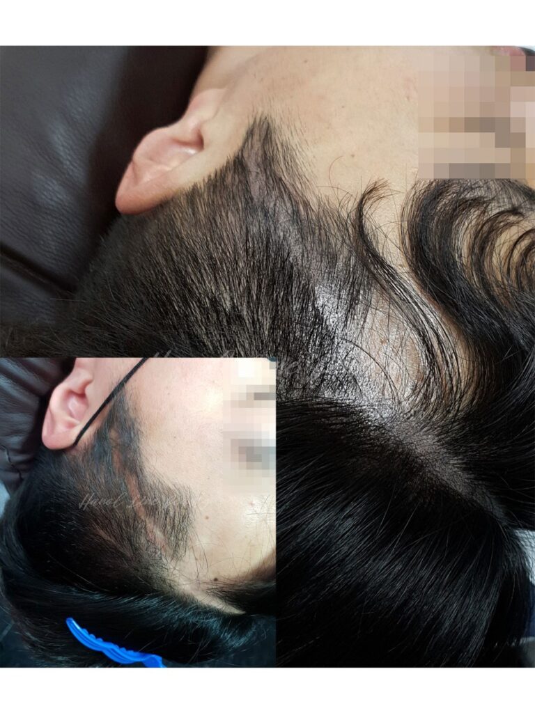 일산두피문신잘하는곳