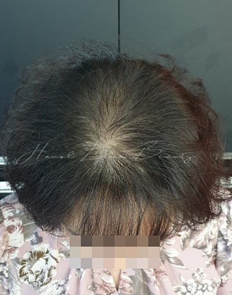 김포두피문신