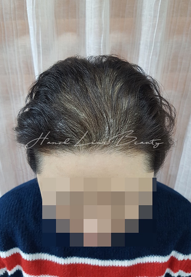 일산두피문신