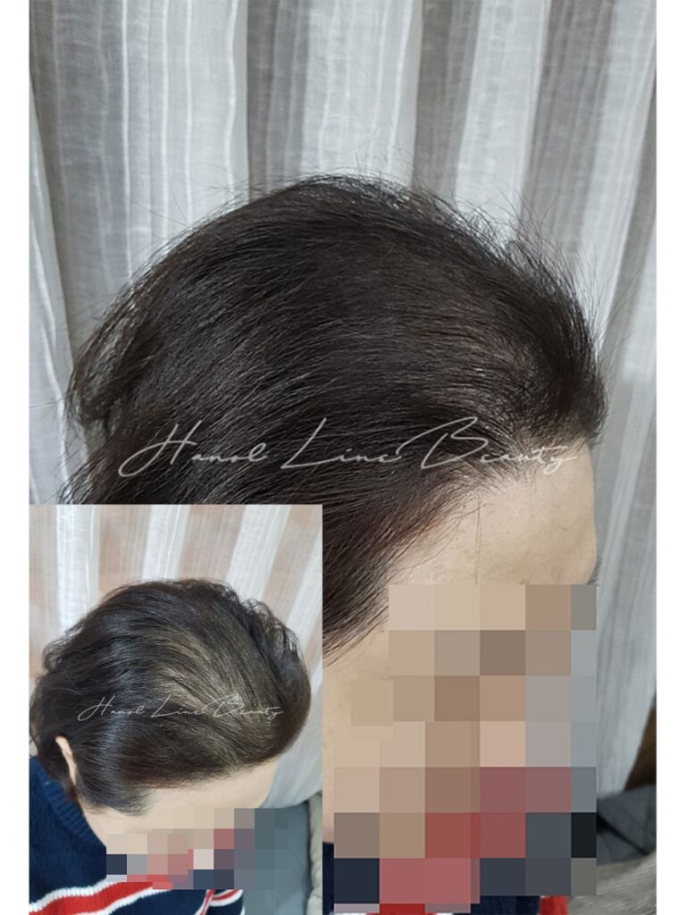 장항동두피문신
